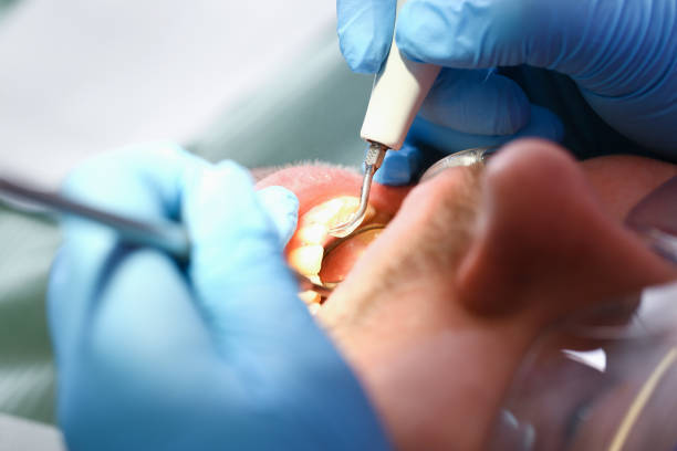 Best Emergency Treatment for Dental Infections or Abscesses in Florham Park, NJ